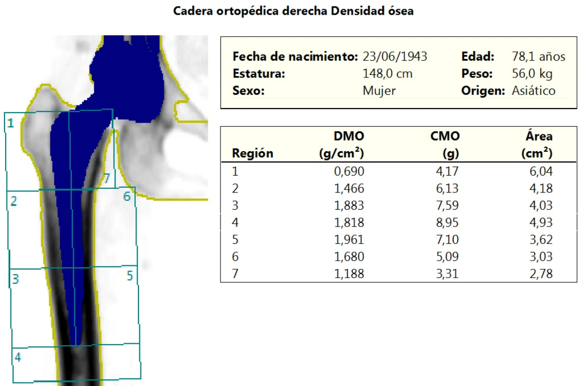 Estudio cadera protesica