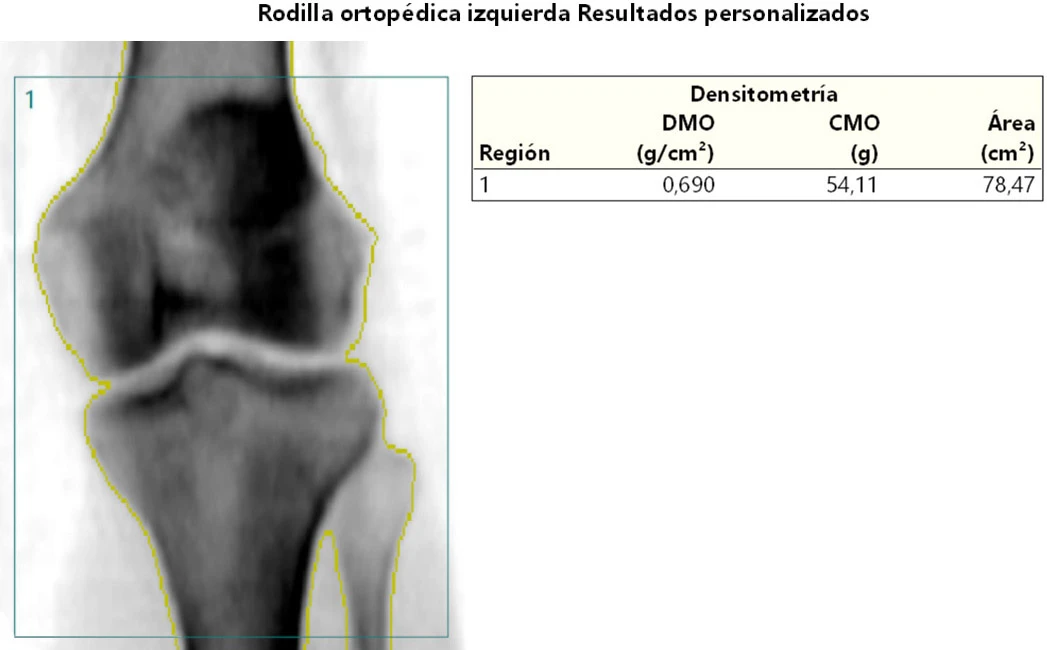 Densitometria ósea de rodillas
