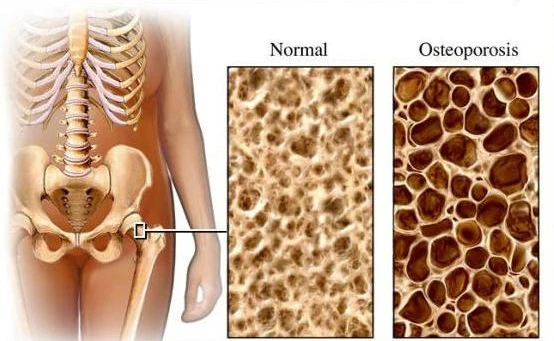 Osteoporosis